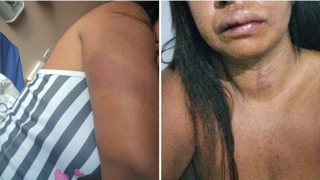 Mulher torturada pelo ex-marido passa por cirurgia, segue internada no Hospital Regional e faz campanha de doações